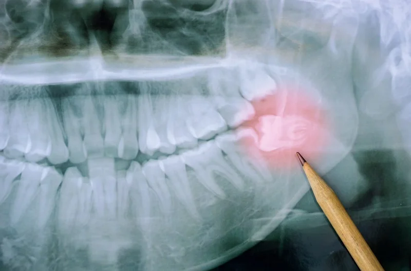 A dental X-ray with a wisdom tooth highlighted