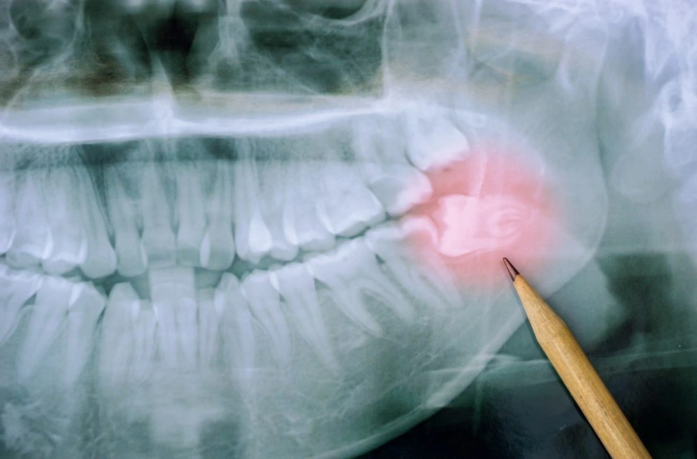 A dental X-ray with a wisdom tooth highlighted