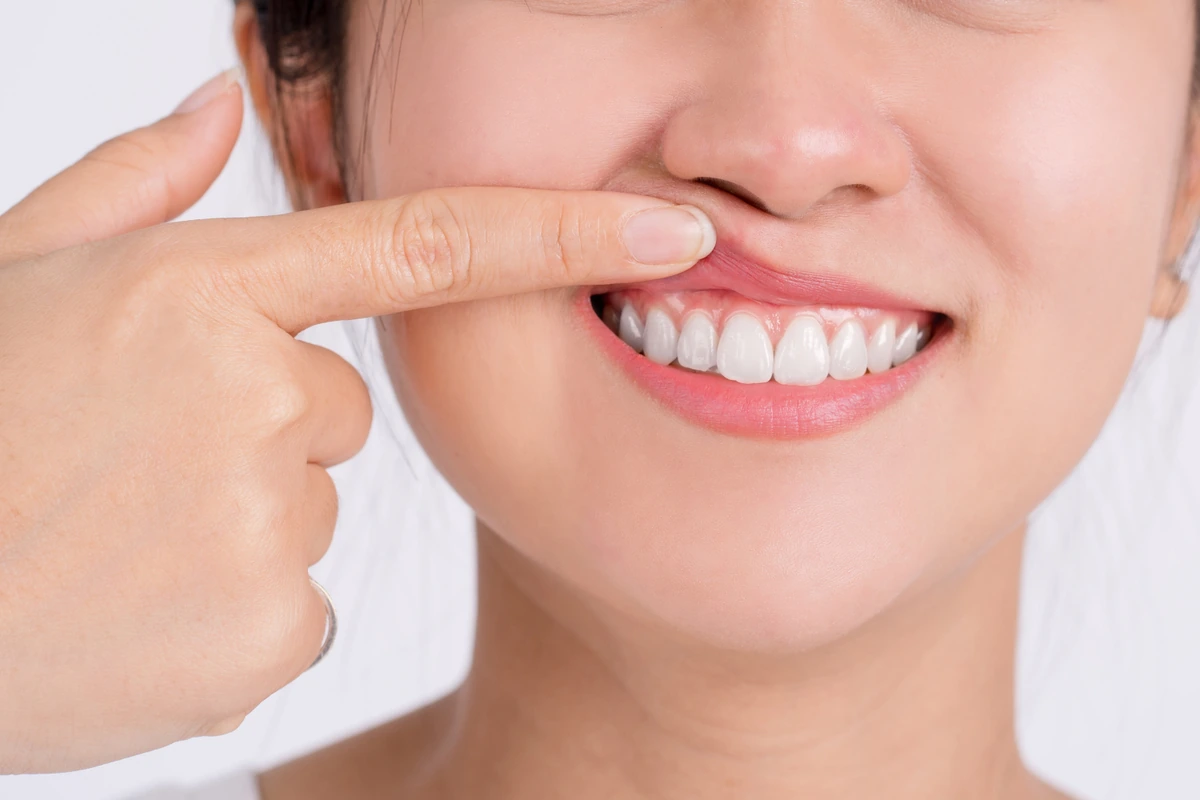 Gum disease treatment Paso Robles Gum disease treatment Paso Robles