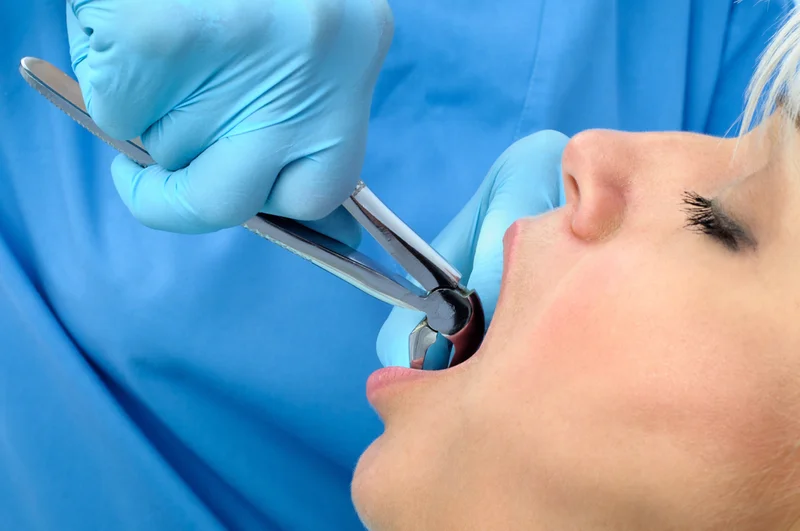 Paso Robles tooth extractions